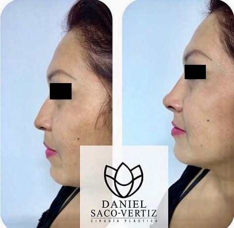 Rinoplastia en Lima Peru Cirugía de Nariz Precio y Procedimiento