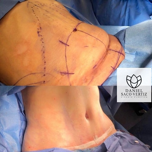 Abdominoplastia en Lima, Peru Cirugía Estética ¡Abdomen Plana Ya!