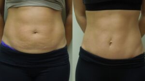 Mini Abdominoplastia en Lima - Cirugía Plástica Especializada en Peru