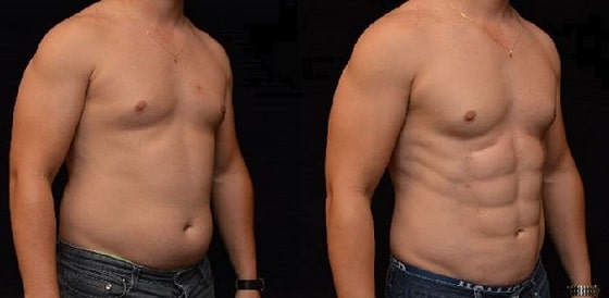 Abdominoplastia: Cirugía de Abdomen en Lima Perú