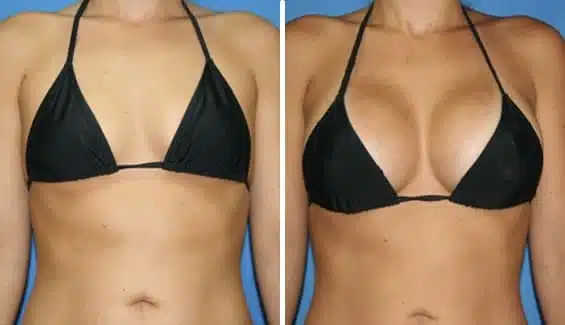 Breast Augmentation Mammoplasty Cosmetic Plastic Surgery in Peru