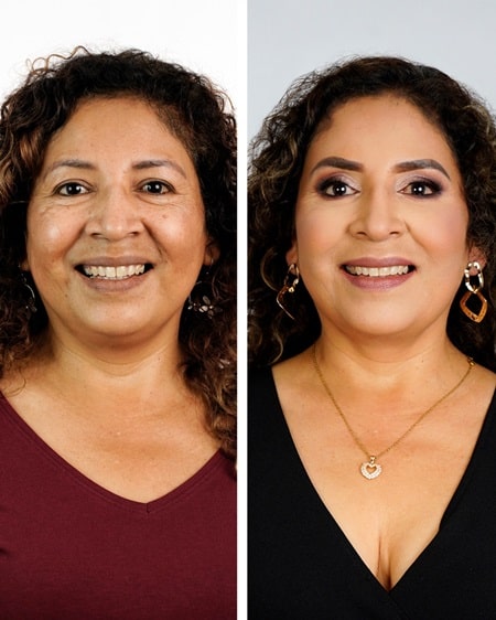 Lifting Facial sin Cirugía en Lima, Perú ✔️