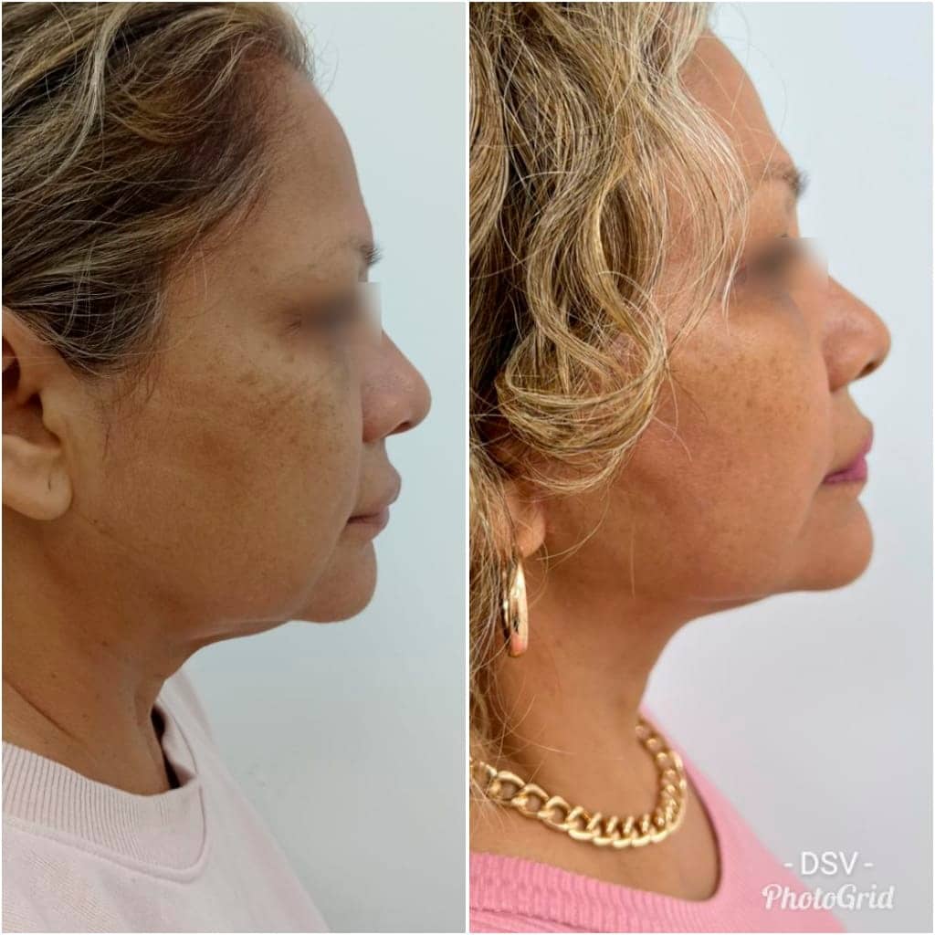 Estiramiento Facial y Cuello Combinado Cirugía Plástica en Peru